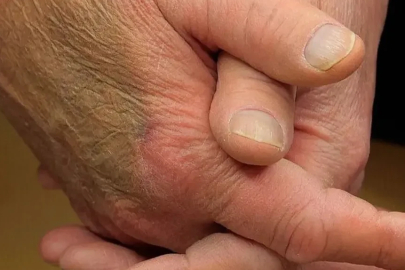 Trump ellerindeki morluğun sebebini açıkladı: Tam 25 yıldır kullanıyor! Doktorların önerdiğinden bile fazla