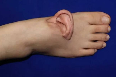 Kopan kulak geçici olarak ayağa nakledildi