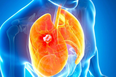 Akciğer kanserinin en erken evresini saptayabilen kan testi geliştirildi