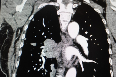 Profesörden korkutan uyarı: Son 10 yılda yüzde 38 arttı!