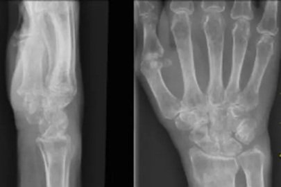 Bursa'da sessiz ilerleyen risk osteoporoza dikkat çekildi