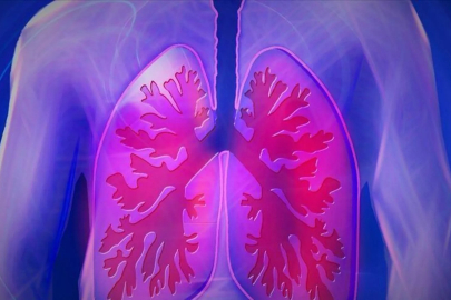 Ağır geçirilen Kovid veya grip yıllar sonra akciğer kanseri riskini artırabilir