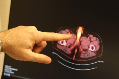 Dünyada 60 vaka var, sonuncusu Diyarbakır'dan: Hastanın penisi alındı!