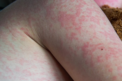 Bangladeş'te kızamık salgını: 113 çocuk öldü