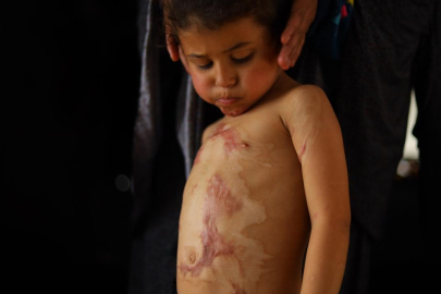 Gazze'de yanık hastaları için tıbbi malzemeler tükenmek üzere