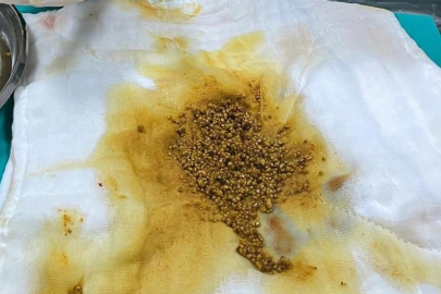 Hastanın ameliyatında 2 bin 67 taş çıkarıldı