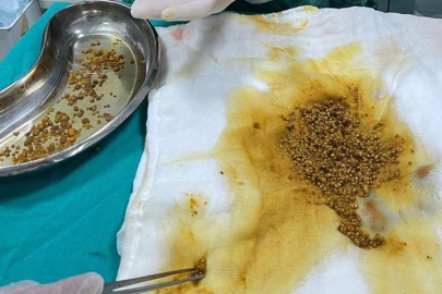 Karın ağrısıyla gitti çıkanlar şok etti! Safra kesesinden 2 bin 67 taş çıkarıldı