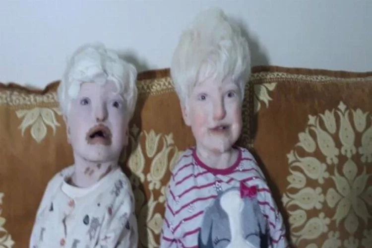 Kız kardeşler hem albino hem de duyma ve konuşma engelli...