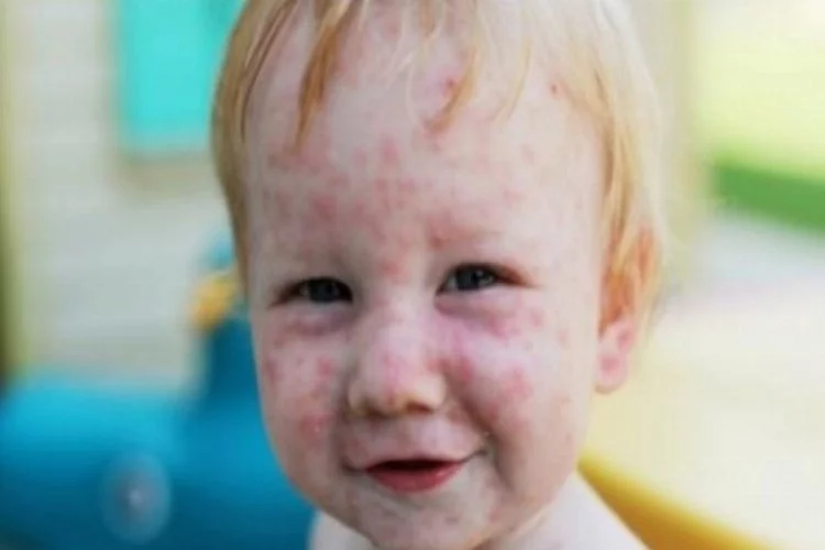 Çocuklarda oldukça sık görülen Kelebek hastalığı nedir?