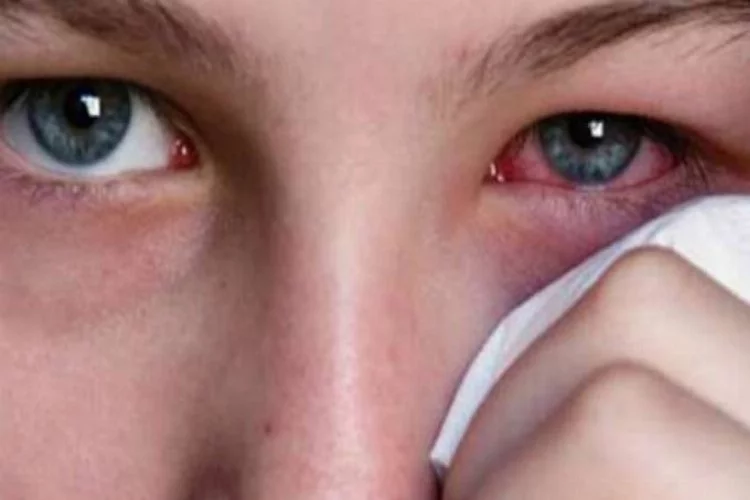 Göz alerjisi deyip geçmeyin! Kalıcı hasarlara sebep olabiliyor