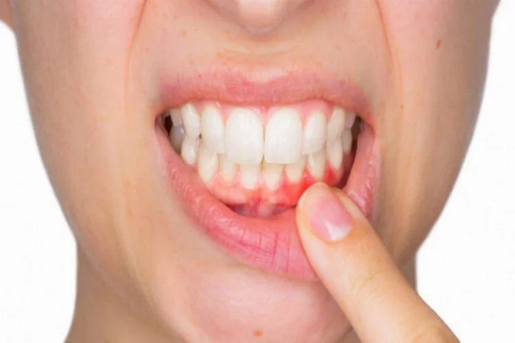 Diş eti problemleri ciddi hastalıkları tetikleyebilir