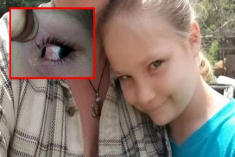 6 yaşındaki kızın gözünden bezelye tanesi büyüklüğünde böcek çıktı
