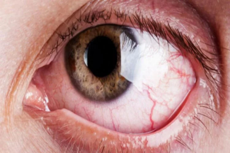 Tatilcilere 'kırmızı göz hastalığı' uyarısı
