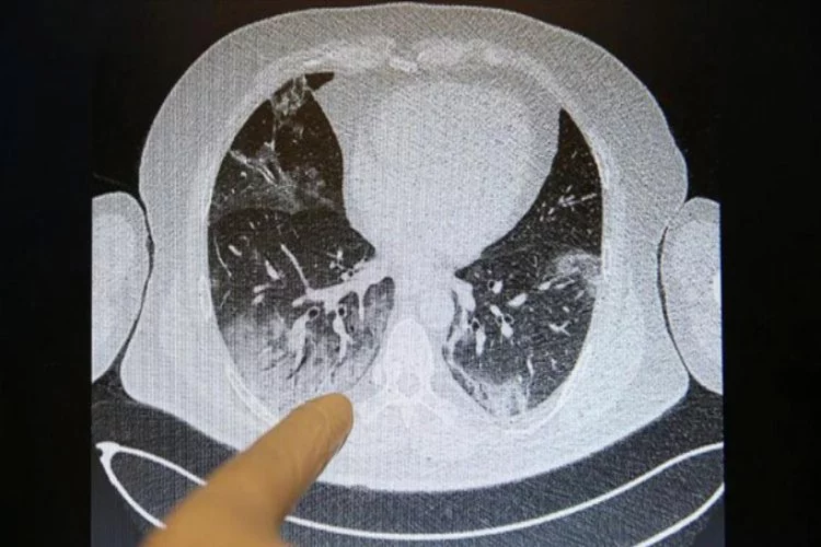 Virüsün akciğerlere verdiği zarar tomografi görüntülerine yansıyor