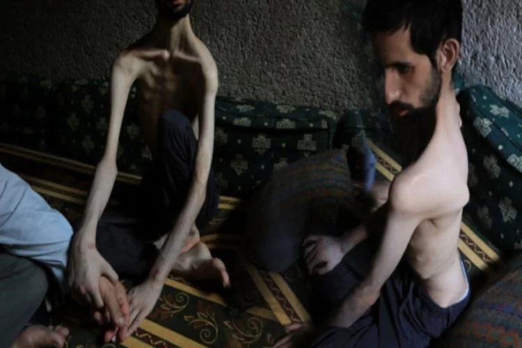 Esad zulmü altında 35 kiloya kadar düşmüştü! İnanılmaz değişim