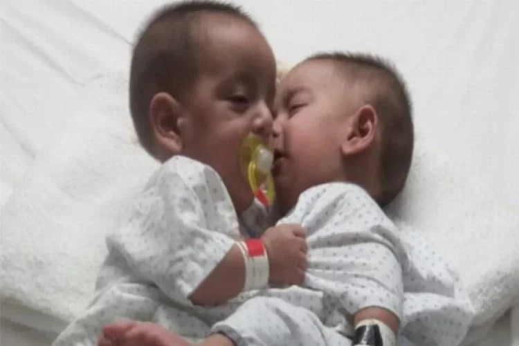 Pakistan'da 9 aylık yapışık ikizler ameliyatla ayrıldı