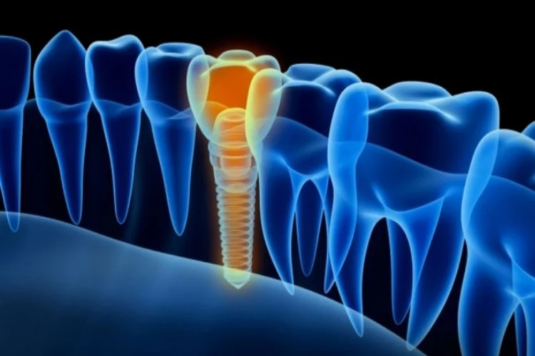Kayıp dişleriniz için implant tedavisi tercih edin