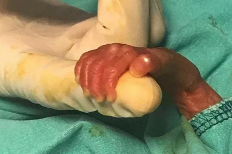 540 gramlık parmak bebeği kök hücre tedavisi hayata bağladı