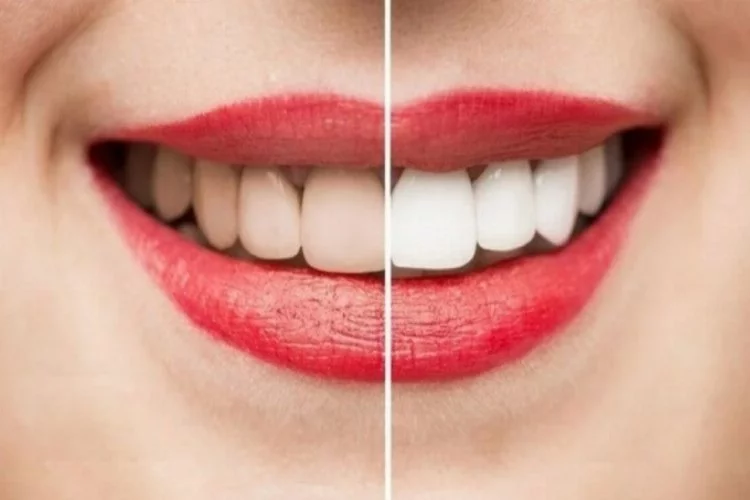 Bursa'da diş beyazlatma (Bleaching) nerede yaptırılır? Diş beyazlatma yöntemleri nelerdir?