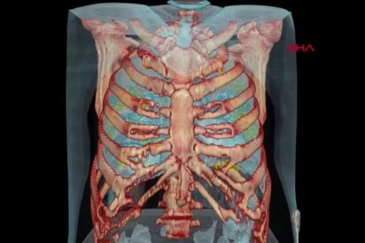 İşte koronavirüslü akciğerin 3D görüntüsü