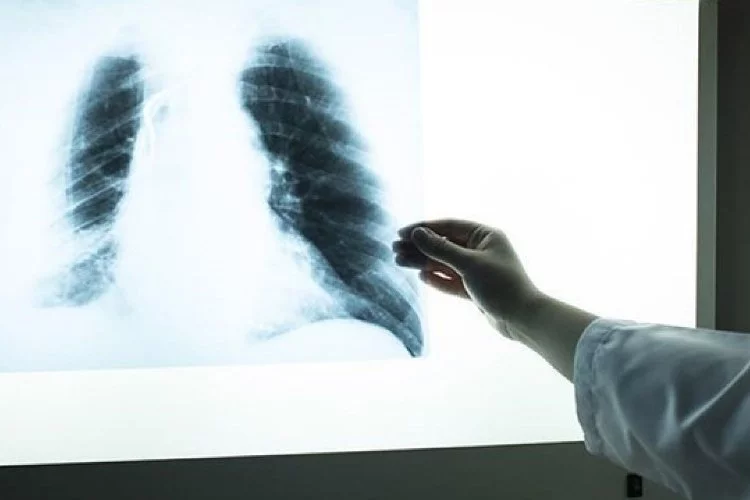 Erkekler, kadınlara göre 3,5 kat daha fazla akciğer kanserine yakalanıyor