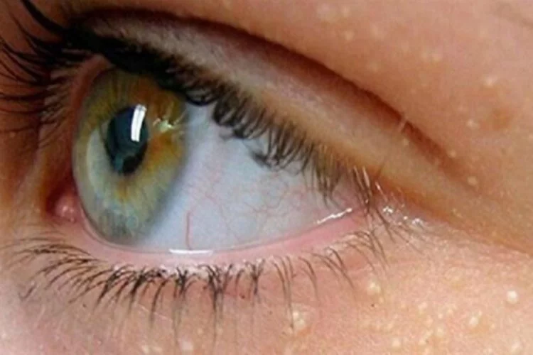 Göz çevresindeki yağ bezeleri neden oluşur?